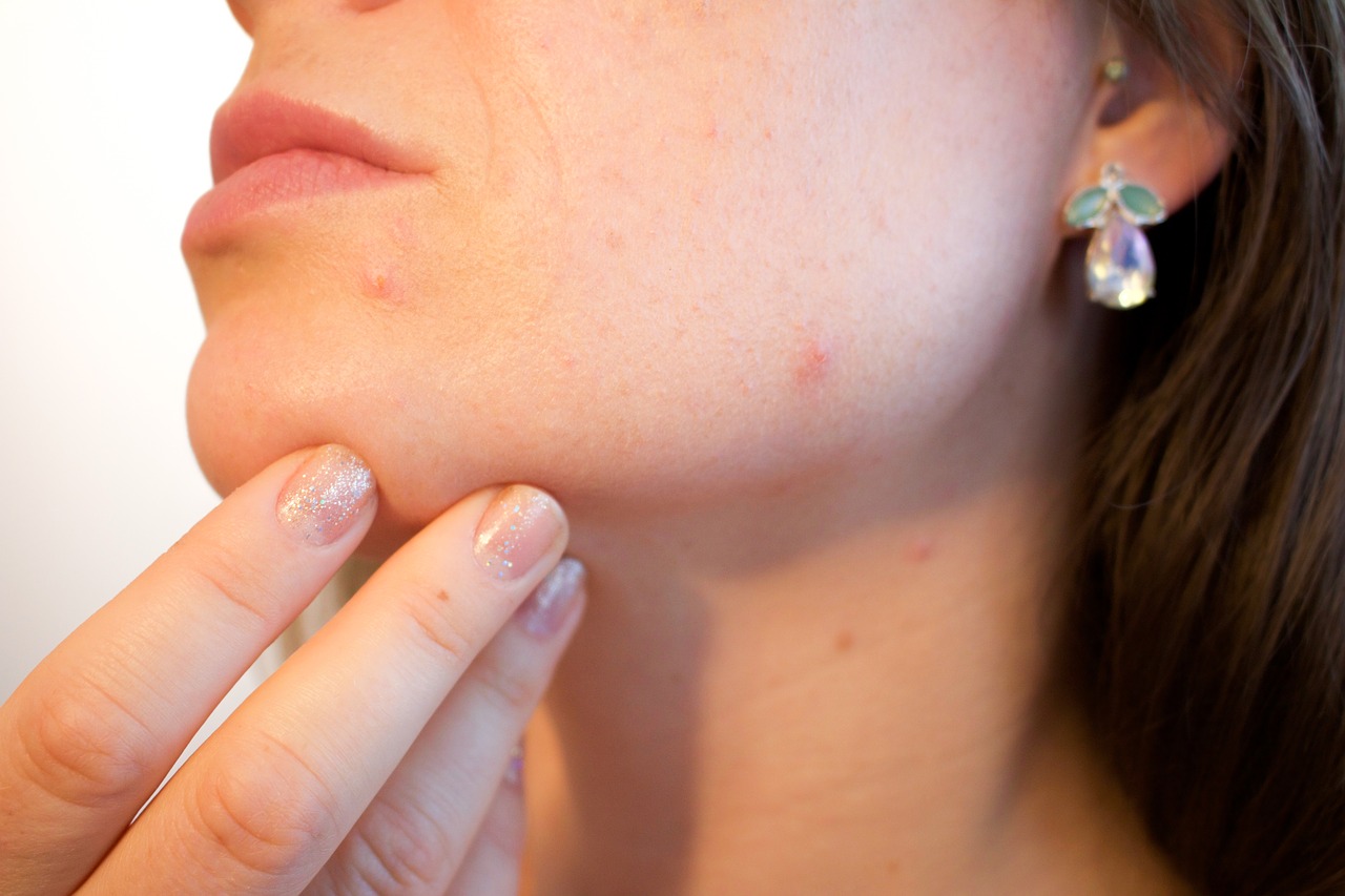 kosmetyki SVR przeznaczone są dla skóry z problemami takimi jak trądzik